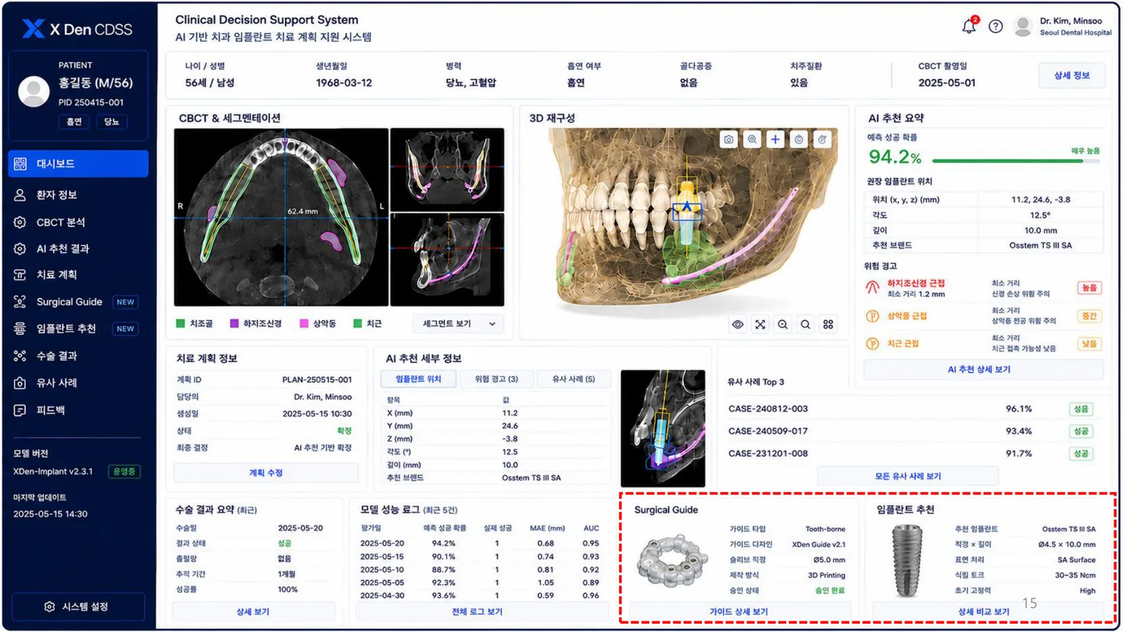AI CDSS UI showing CBCT segmentation, 3D reconstruction, risk warning, implant recommendation, and surgical guide recommendation